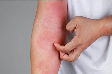 Atopic dermatitis more than skin